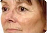 Wrinkles, before treatment, as shown in the product brochure
