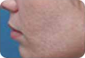 Acne scars, before treatment, as shown in the product brochure