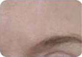 Scars, after treatment, as shown in the product brochure